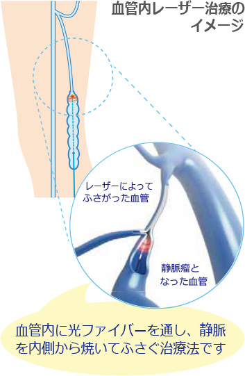 血管内レーザー治療のイメージ